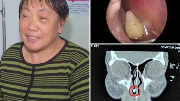 A avut simptome de răceală ani la rând. Când a ajuns la spital, medicii au avut un șoc