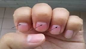 Indiciul prețios despre sănătatea ta stă la baza unui semn. Verifică-ţi unghiile, ascund BOLI GRAVE!