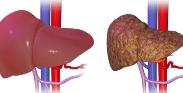 Boala silenţioasă de ficat care duce la CANCER. Din ce în ce mai mulţi români suferă de aşa ceva