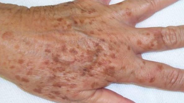 Scapă de petele de bătrâneţe de pe mâini, gât şi faţă cu acest remediu simplu 
