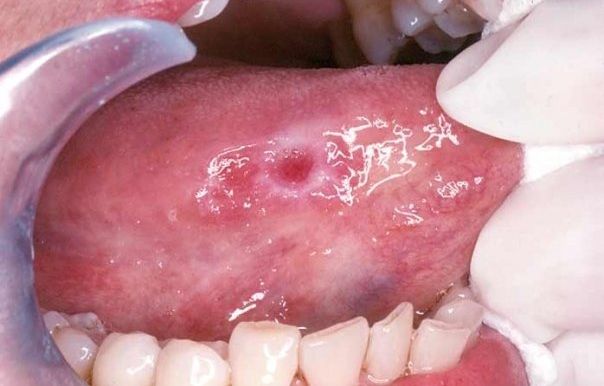 Sute de români diagnosticați în 2016 cu această boală cumplită. Iată primele simptome