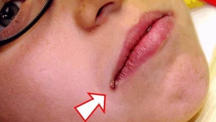 Ţi-a apărut o astfel crăpătură în colţul gurii? Iată motivul pe care medicii evită să îl spună