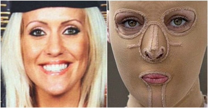 I-a dat foc acestei blonde din cauză că era prea frumoasă. Cum arată fata după reconstrucţia pielii