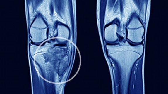Tot mai multe cazuri de CANCER OSOS: cauze, simptome, tratament 