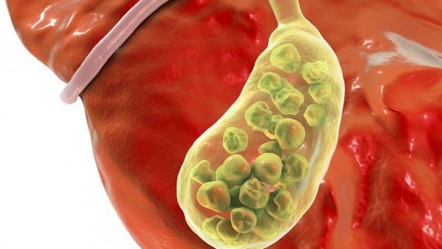 Cum scapi de o criză de fiere în 15 minute