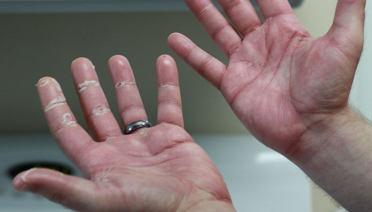 Simptomele cancerului apar prima dată pe mână. Cum arată