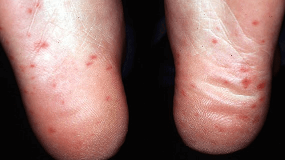 Ce este boala mână-gură-picior. Află cât de periculoasă este! 