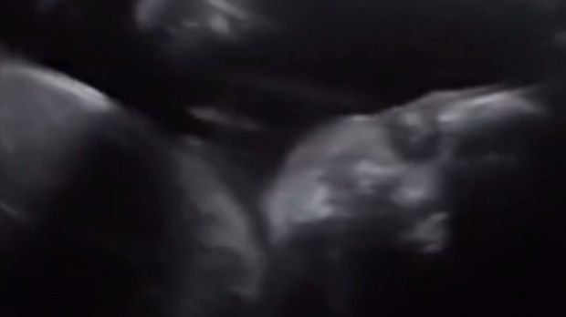 Se uitau la o ecografia bebelușului lor. Ce a urmat este foarte bizar