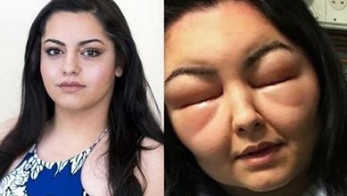 S-a ales cu faţa umflată şi cu orbire temporară după ce a făcut o greşeală pe care multe femei o fac