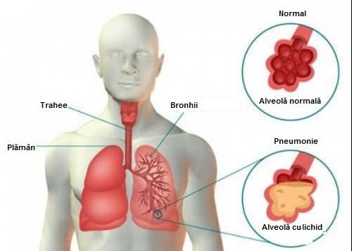 Ai aceste simptome? Mergi de urgenţă la medic. E PNEUMONIE!