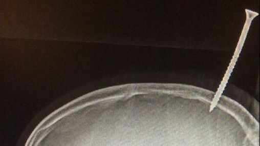 Caz medical înfricoșător: Un șurub de 15 cm a perforat creierul unui băiat de 13 ani