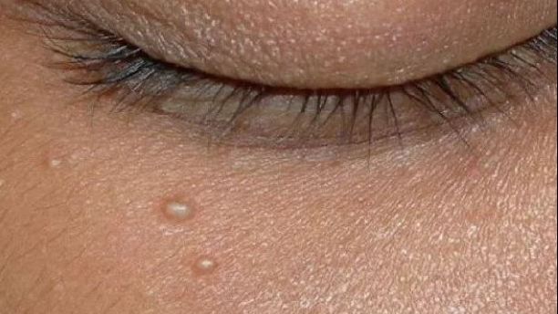 Ce înseamnă micile umflături albe de pe față