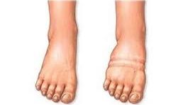 Ce trebuie să faci pentru a scăpa de retenția de apă. Iată ce spun specialiștii!