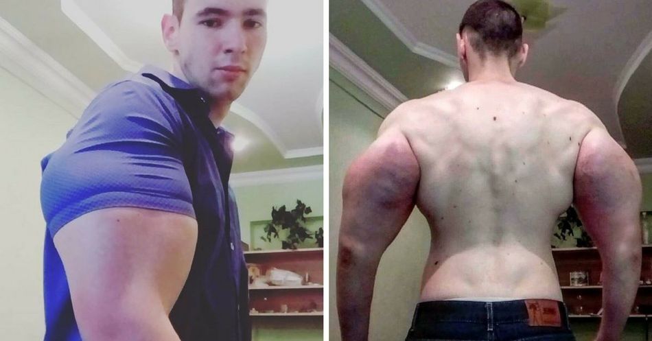 Rusia uimeşte iar! A dat lumii un "Popeye" real. Şi-a injectat chimicale, acum e aproape de moarte