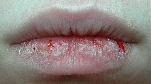 De ce se usucă buzele și ce rol are stresul în acest proces