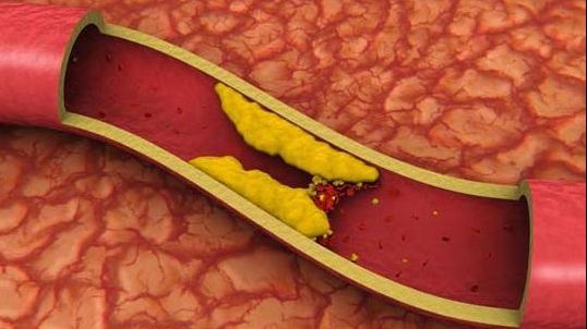 Colesterolul îți distruge atât inima, cât și creierul. Află cum îl poți ține sub control