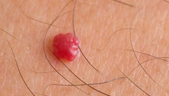 A observat că are câteva ALUNIŢE ROŞII pe corp şi s-a dus la medic. GROAZNIC! Ce i-a zis doctorul?