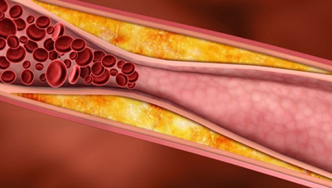 Semne silenţioase care îţi spun că ai arterele înfundate şi că rişti afecţiuni grave