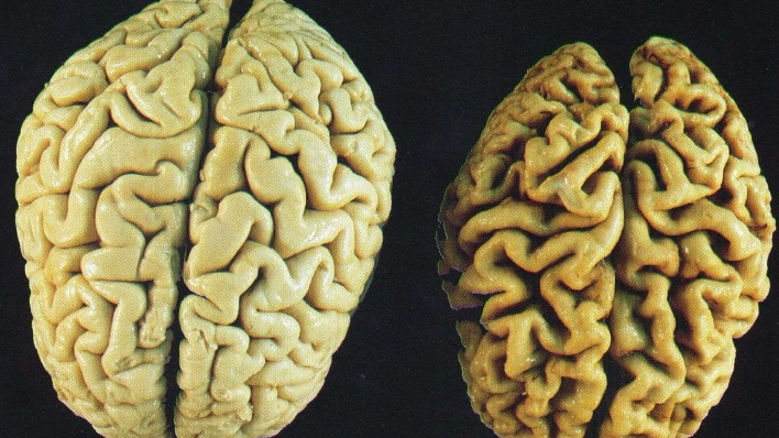 Un simplu "transplant" de materii fecale ar putea rezolva probleme degenerative ale... creierului 