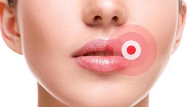 Cum să scapi de herpes. Remedii naturiste care fac minuni peste noapte