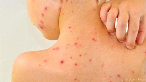 Părinții au ajuns să NU mai declare infecția cu rujeolă medicului de familie! Situație alarmantă