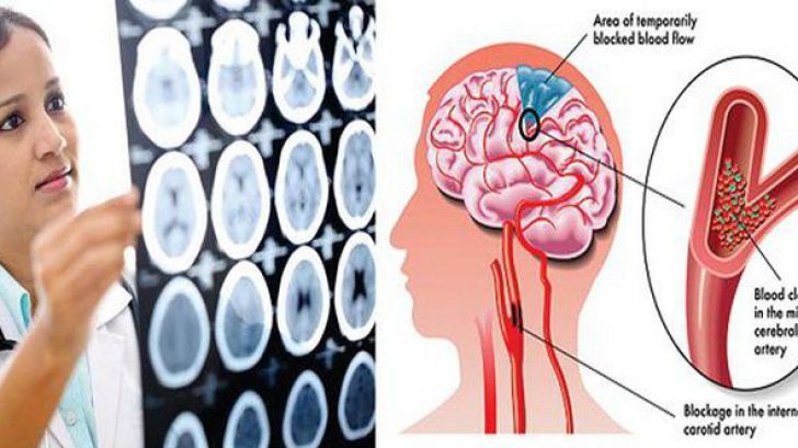 Semne clare care îţi spun că durerea de cap pe care o ai poate fi fatală