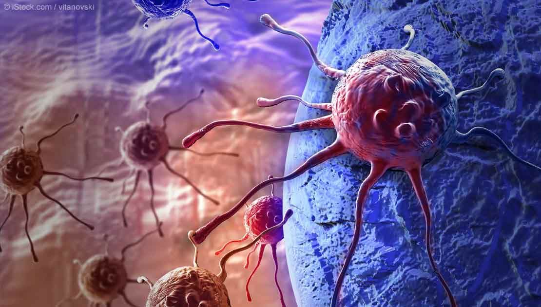 Cancerul ascuns care poate trece neobservat luni de zile. Simptomul banal, ignorat de mulţi