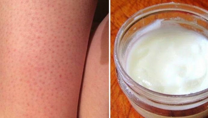 Amestecul care te ajută să scapi de punctele roşii de pe picioare