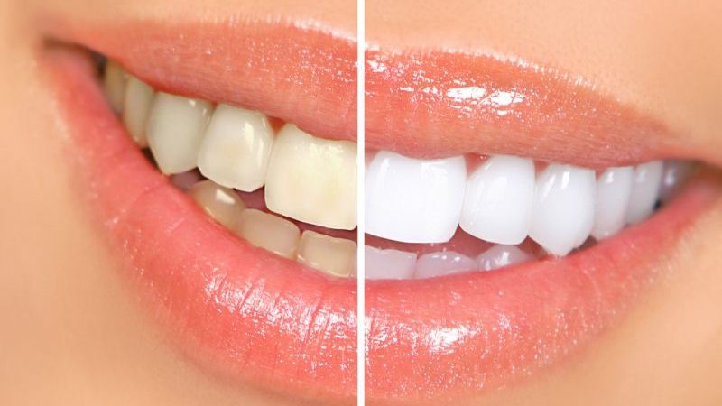 Cum să îţi albeşti dinţii cu un singur ingredient