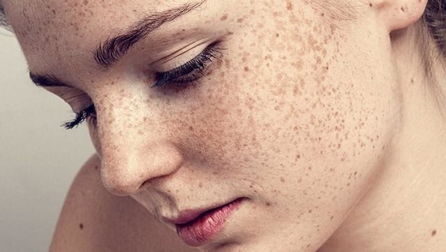 Remediile naturiste care te scapă de pistrui