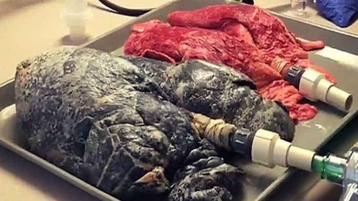 Diferența dintre plămânii unui fumător şi ai unui nefumător. Un medic arată un video tulburător