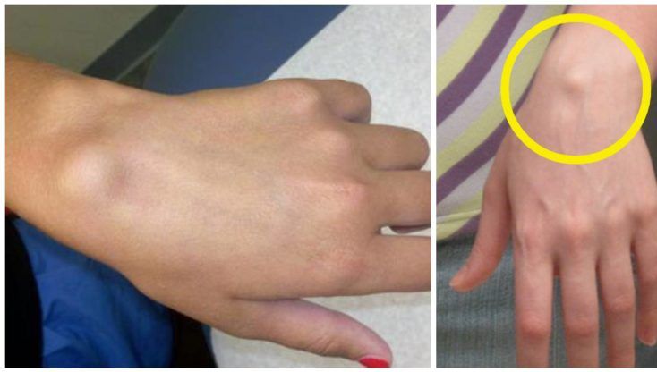 Ţi-a apărut o astfel de umflătură la încheietura mâinii? Iată ce ţi s-a întâmplat!
