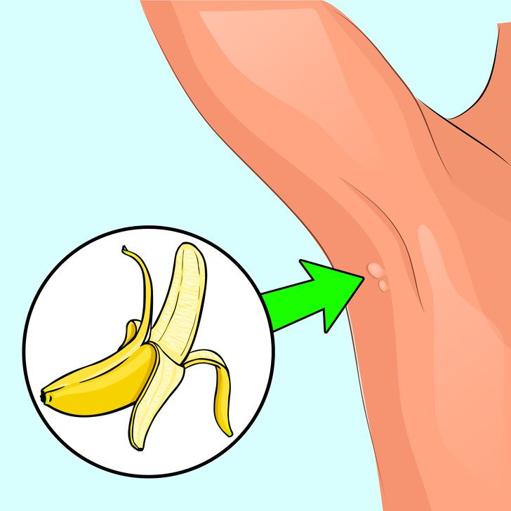 Cum să scapi de negi pentru totdeauna 