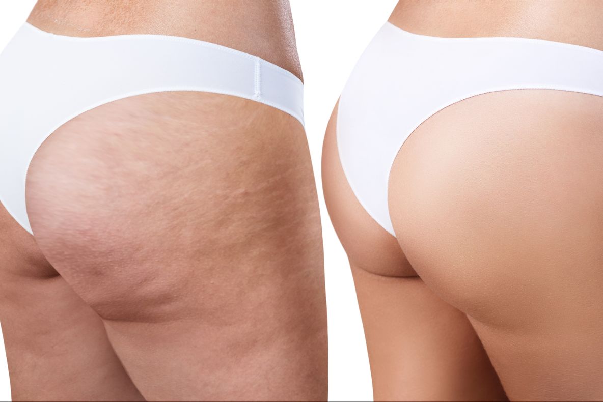 Cum scapi rapid de celulită. Remediul ţinut secret 