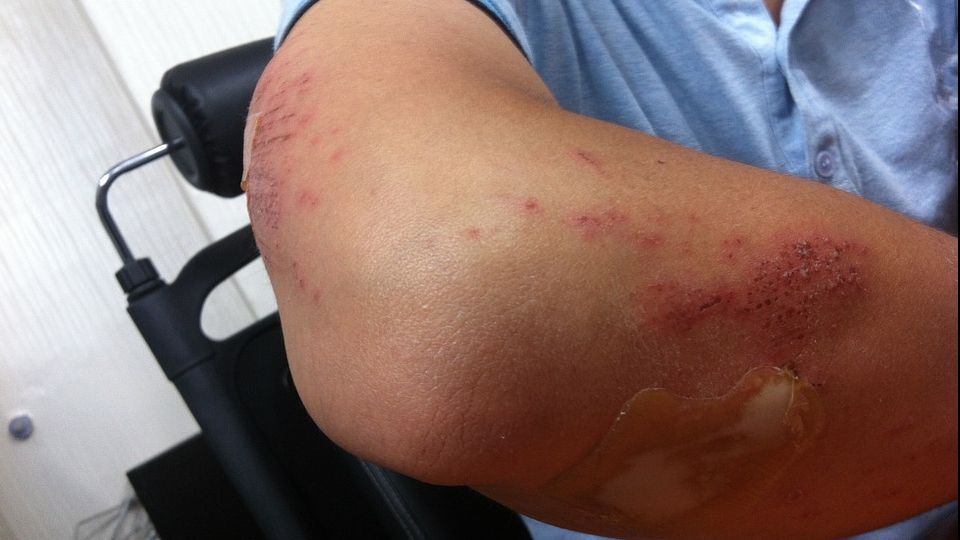 Nu știai asta. Ce înseamnă dacă rănile tale se învinețesc repede