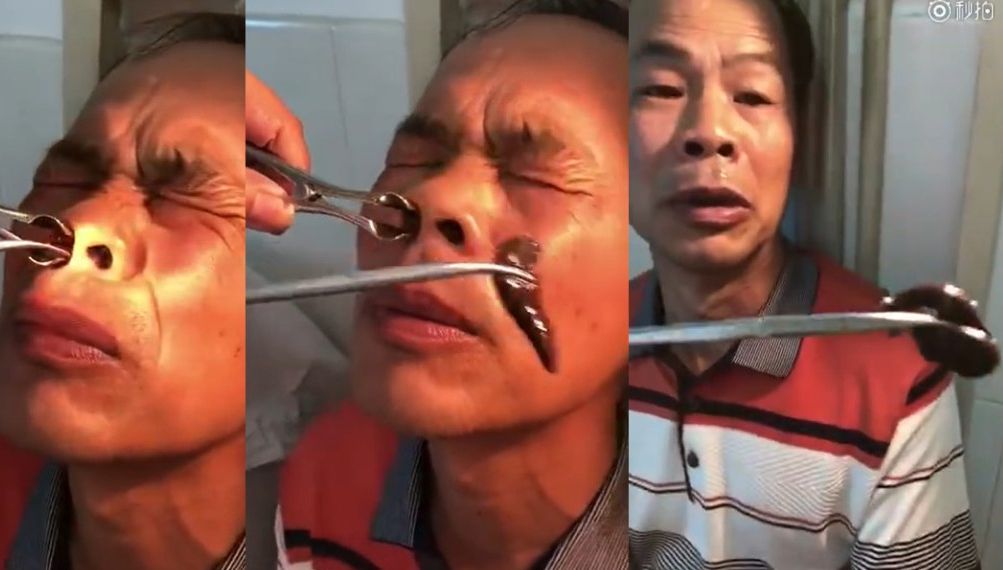 Se plângea de sângerări nazale. Motivul l-a îngrozit. Doctorul i-a scos cu greu creatura din nas