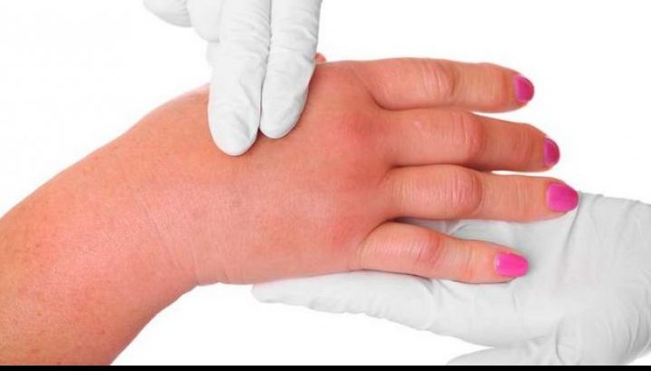 Ai mâinile umflate? Iată câteva remedii naturale!