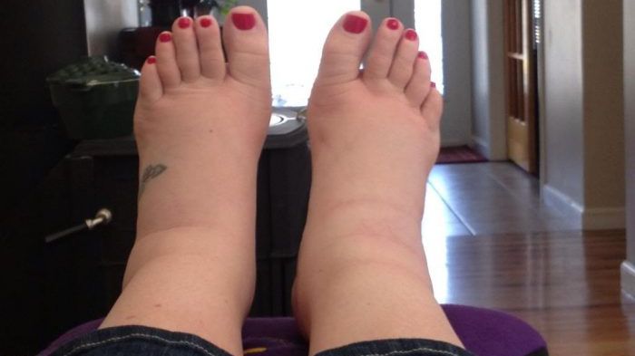 Cum poți scăpa de picioarele umflate 