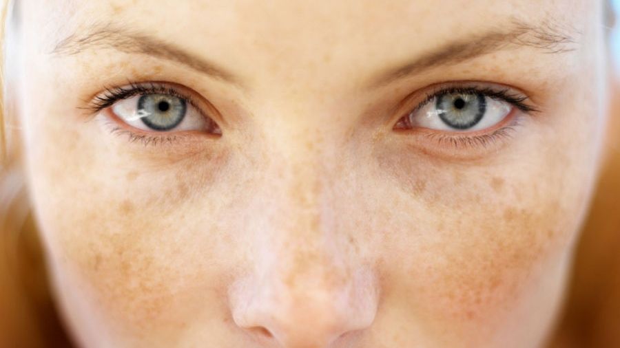 A venit vara: remedii eficiente împotriva petelor solare