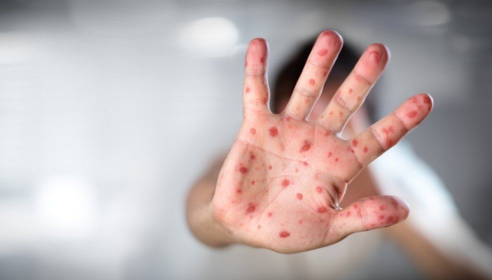 Alte două persoane au murit din cauza rujeolei, în România