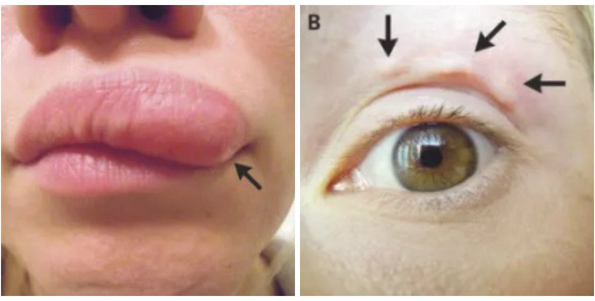 Avea o umflătură care se plimba pe faţă. Au operat-o, iar ce au găsit sub piele este îngrozitor