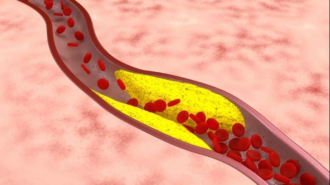 Cum poți preveni ateroscleroza. Iată alimentele care îți pot salva viața!