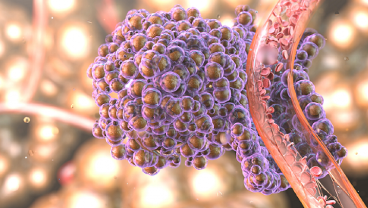 Alimentul care răspândește cancerul în tot corpul. Îl ai sigur în casă. Renunță la el cât mai rapid