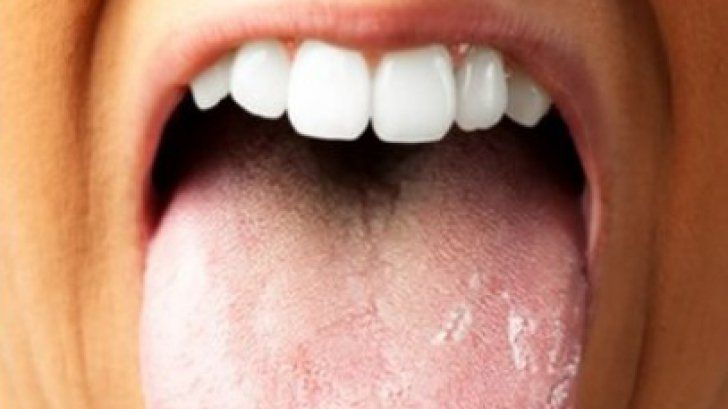 Ai limba crăpată la vârf? Mergi urgent la medic! E vorba despre o boală cumplită!