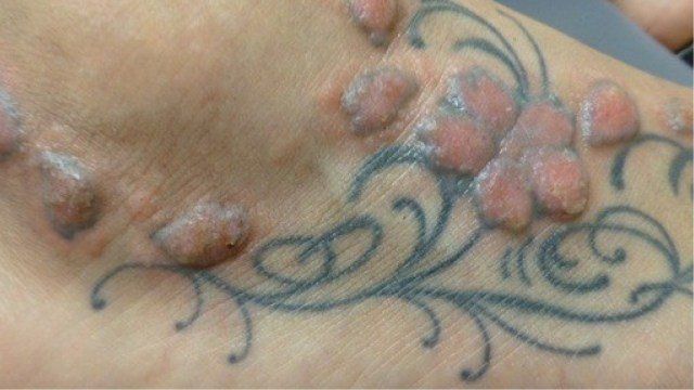 Avertisment dur pentru cei care se gândesc să-şi facă un tatuaj