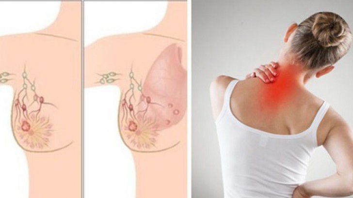 Primele simptome ale cancerului mamar. Când e durerea de sân un semn de alarmă