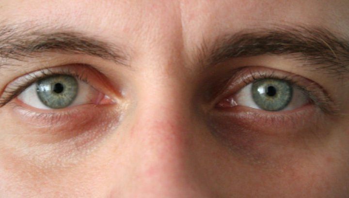 Super-truc! Cum scapi rapid de cearcăne