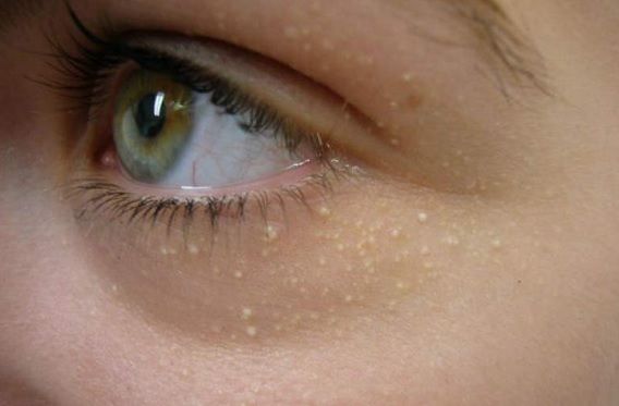 De ce apar, de fapt, punctele de grăsime de pe faţă