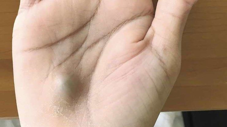 Dacă vezi o astfel de umflătură în palmă, mergi de urgenţă la spital!