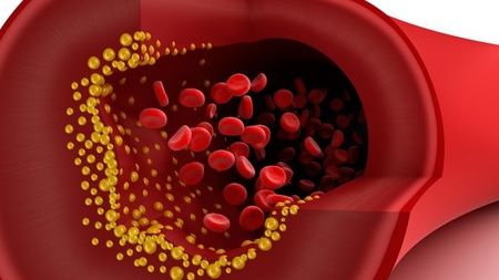 Remediul 100% natural pentru reducerea hipertensiunii arteriale